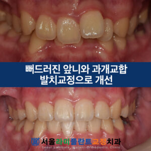 동탄교정치과추천