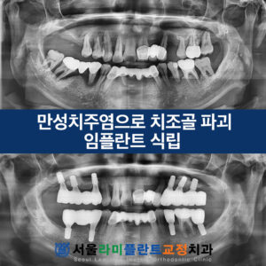 서울라미플란트교정치과 증례썸네일