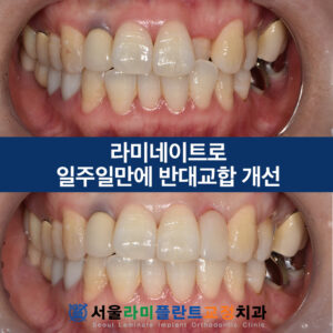 서울라미플란트교정치과 증례썸네일