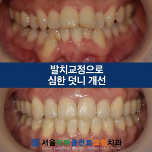 서울라미플란트교정치과 증례썸네일