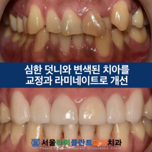 서울라미플란트교정치과 증례썸네일