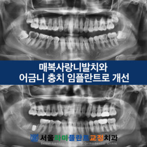 동탄사랑니발치