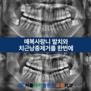 서울라미플란트교정치과_증례썸네일