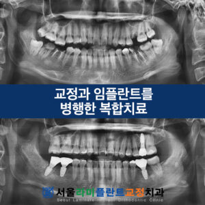 서울라미플란트교정치과 증례썸네일