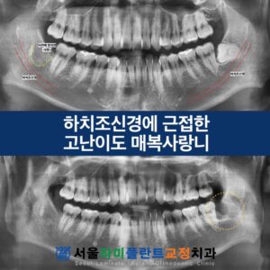 서울라미플란트교정치과_증례썸네일