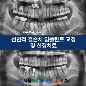 서울라미플란트교정치과 증례썸네일