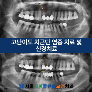 서울라미플란트교정치과_증례썸네일