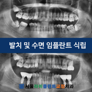 0328 수면 임플란트 증례