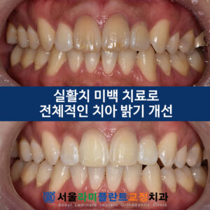 0328 실활치 미백증례