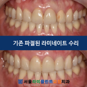 서울라미 라미네이트