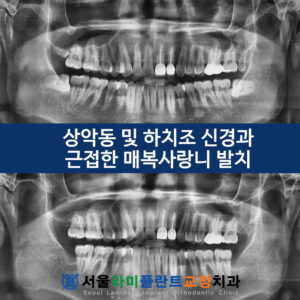서울라미 사랑니