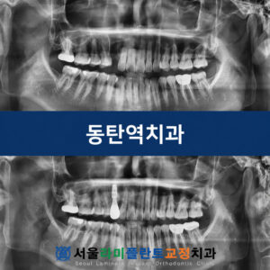 dongtan-bone-graft-implant-1