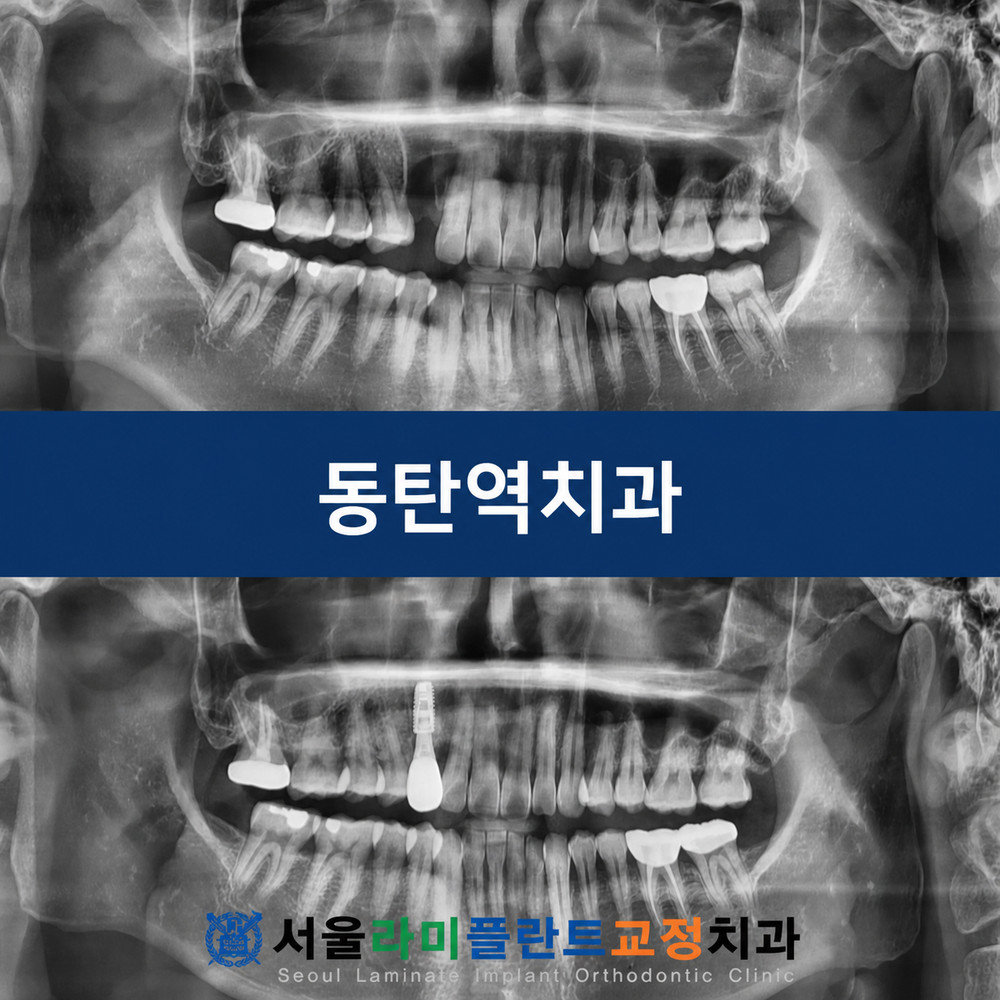 염증으로 인해 심하게 손상된 잇몸뼈의 전반적 상태