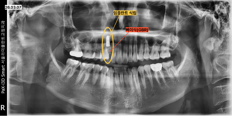 40대 남성의 상악 우측 송곳니 발치 부위