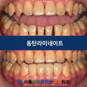 dongtan-dental-veneers-1