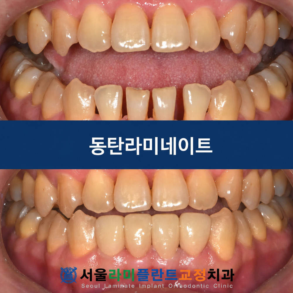 동탄라미네이트 벌어진 앞니 음식물 끼임과 관리 어려움 웃을 때 심미 부담 이유