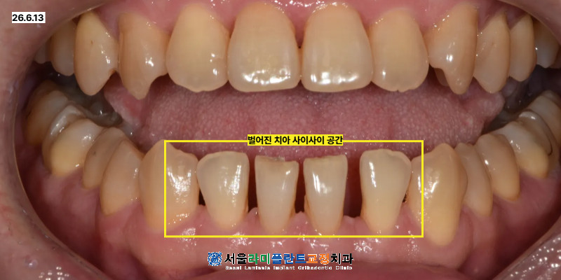 동탄라미네이트 교정 치료 기간과 장치 부담 비교 벌어진 앞니 선택 기준 확인