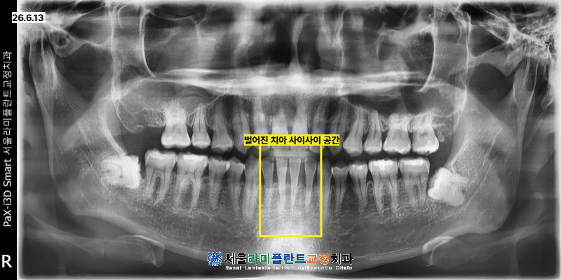 동탄라미네이트 얇은 보철물 부착으로 앞니 틈과 모양 단기간 개선 방법
