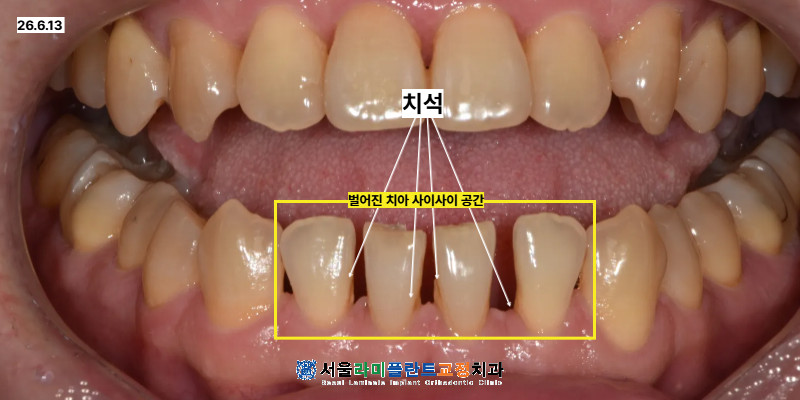동탄라미네이트 앞니 간격 개선 전 자연치아 보존과 과도한 삭제 시림 통증 주의사항
